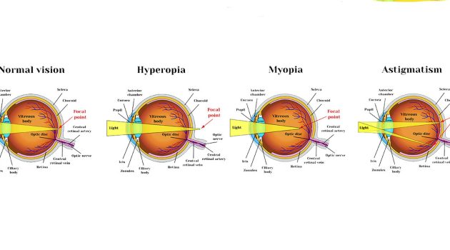 Refractive errors in vision