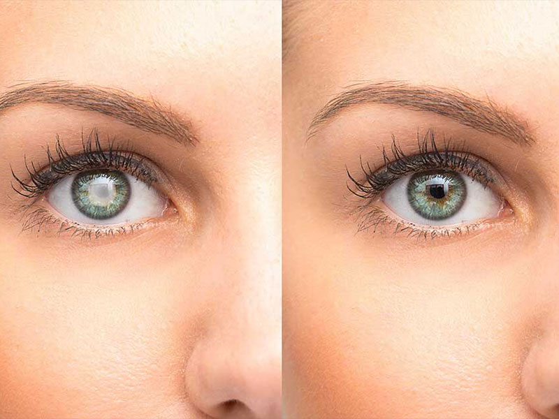 cataract-eye-surgery-treatment-in-woodville-adelaide-sa