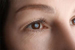 Lady with cataracts growing across her pupil affecting her sight