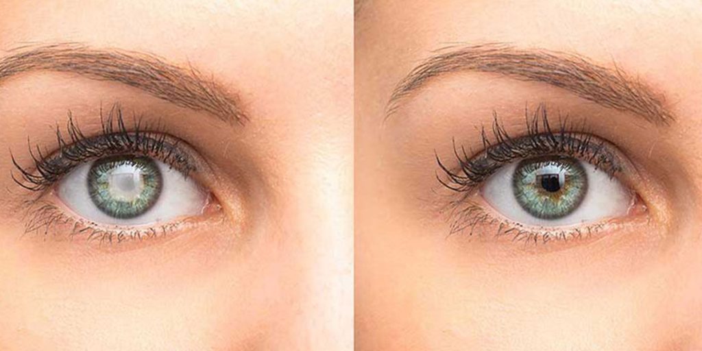 Close up of cataract on the left eye