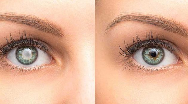 Close up of cataract on the left eye