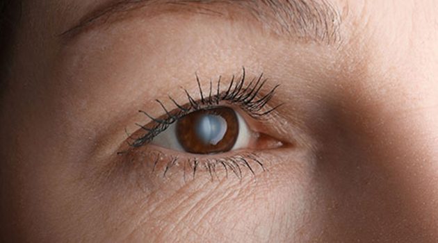 Lady with a cataract