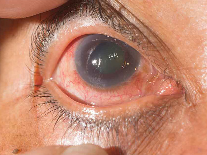 close up of a glaucoma patient with a large glaucoma impairing vision