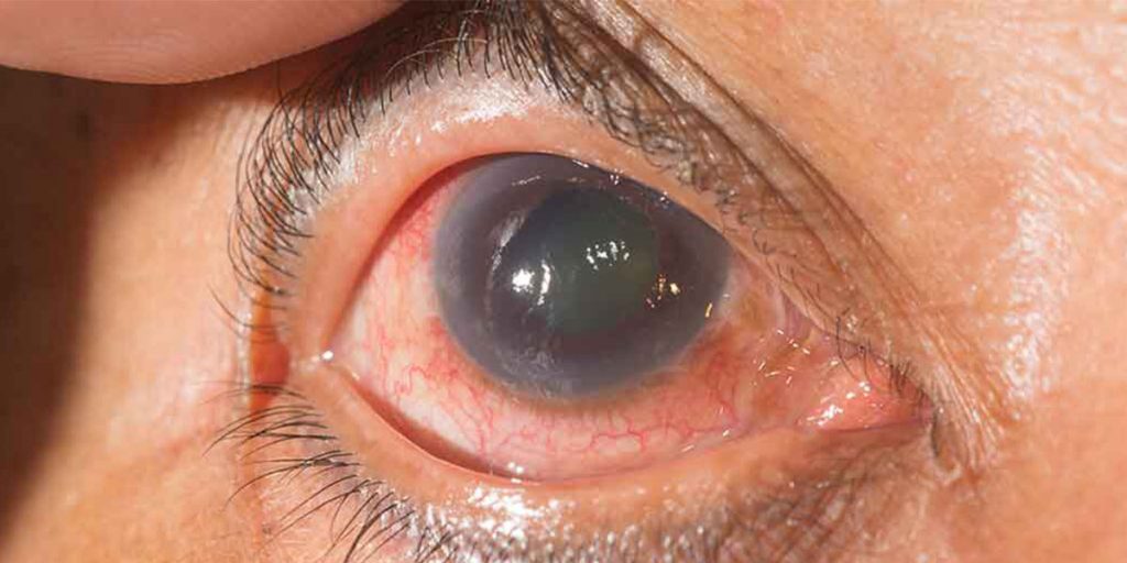 Dr inspecting the eye of a glaucoma patient