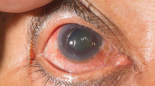 Dr inspecting the eye of a glaucoma patient