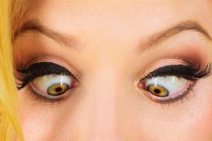Young girl with strabismus