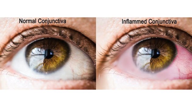Pink eye