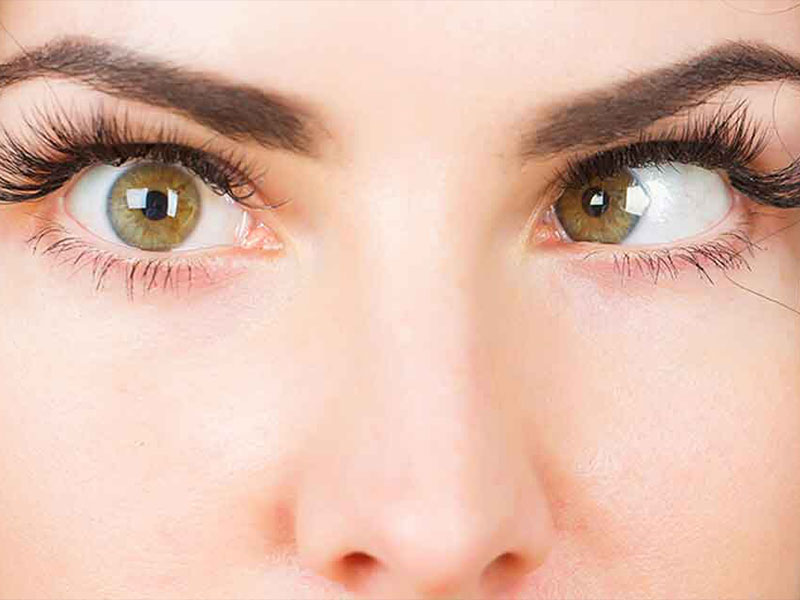 Squint Eye Treatment & Surgery - Dr Qaisar Ahmed