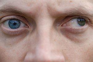 Squint or Strabismus the mans right eye is not looking directly with the left eye.