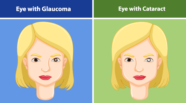 Glaucoma Vs Cataracts